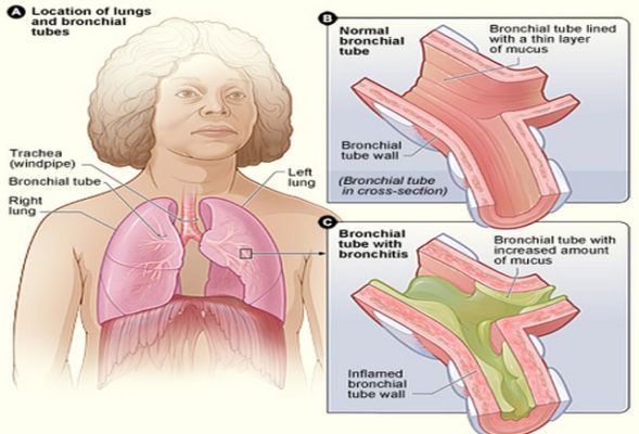 bronquitis grafico bronquios inflamados
