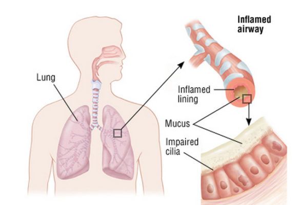 imagen grafico bronquitis cronica aguda