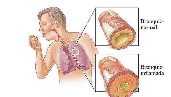 bronquitis aguda y bronquitis cronica