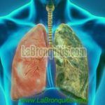 Frecuencia Respiratoria y Volumen Respiratorio 5 Pulmones con bronquitis y tabaquismo