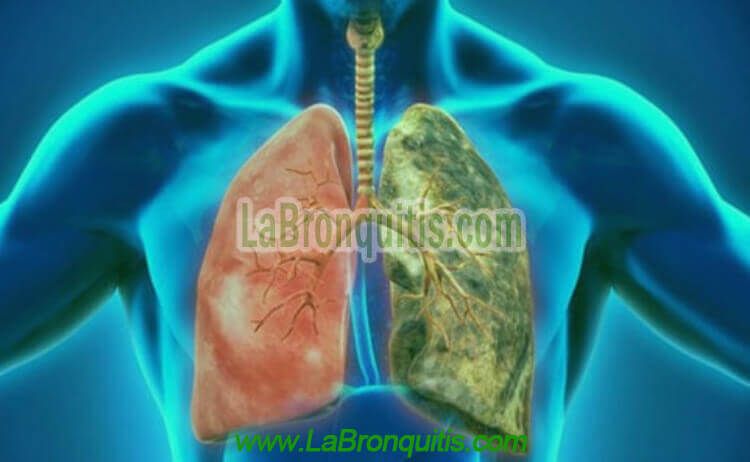 Pulmones con bronquitis y tabaquismo