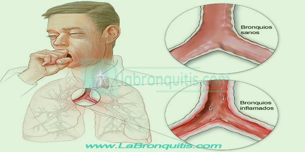 Causas de la bronquitis